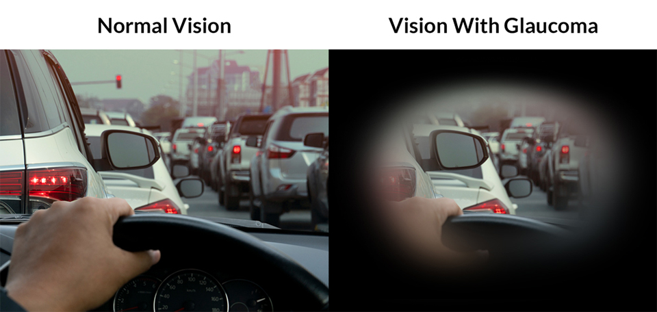 Chart Showing Normal Vision Vs Someone With Glaucoma